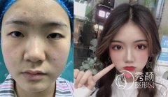 郑州双眼皮修复哪个医生好,田国静 杨丽 贾亮 孟明星等