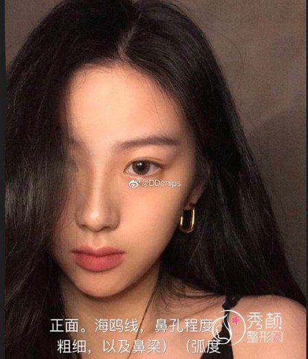 上海隆鼻哪个医生好,上海葛志鑫鼻子做得怎么样
