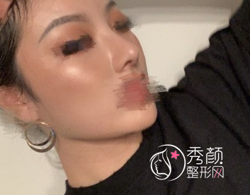 北京八大处王欢做鼻子怎么样 肋骨鼻好看吗