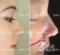 <b>上海陈海标做鼻子怎么样 鼻子风格 案例 靠谱吗</b>