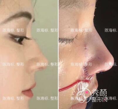 上海陈海标做鼻子怎么样 鼻子风格 案例 靠谱吗