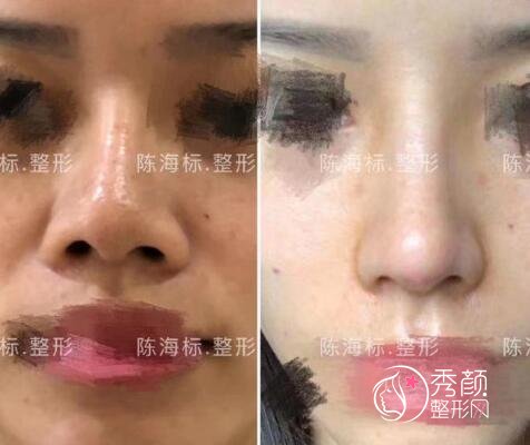 上海陈海标做鼻子怎么样 鼻子风格 案例 靠谱吗