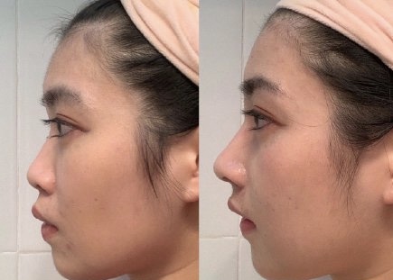 宁波珈禾任东做鼻子怎么样 靠谱吗 价格 案例