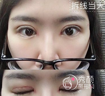 北京做的超自然全切双眼皮+开眼角术后分享。