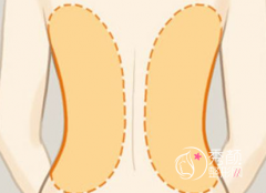 负压吸脂、水动力吸脂、bodytite射频、光纤、冷冻溶脂到底哪种好？