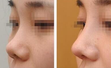 深圳向宏伟隆鼻怎么样 风格 价格