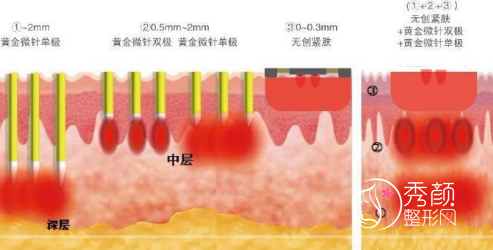 面部负压吸脂和黄金微雕有什么区别？哪个好？