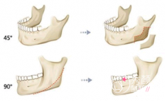 武汉哪个医院磨骨好,哪个医生靠谱?