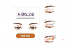 双眼皮修复面诊记录~高寿松、潘贰、刘风卓、吴焱秋、王世勇。