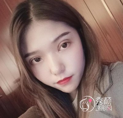 在昆明吴氏嘉美割的双眼皮,大家觉得怎么样?