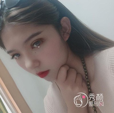 在昆明吴氏嘉美割的双眼皮,大家觉得怎么样?