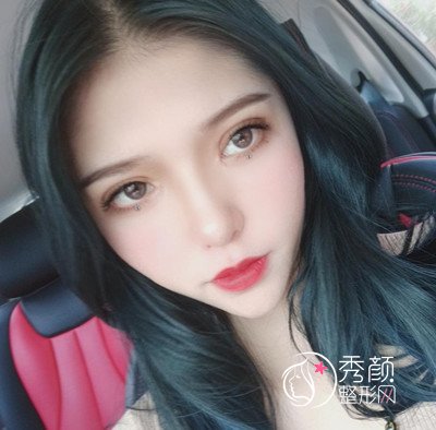 在昆明吴氏嘉美割的双眼皮,大家觉得怎么样?