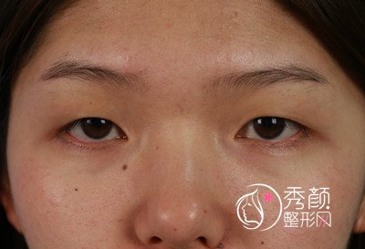 在昆明吴氏嘉美割的双眼皮,大家觉得怎么样?