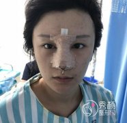北京师俊莉做鼻子怎么样,耳软骨隆鼻案例。