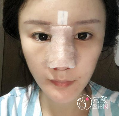 北京师俊莉做鼻子怎么样,耳软骨隆鼻案例。
