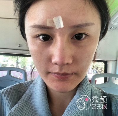 北京师俊莉做鼻子怎么样,耳软骨隆鼻案例。
