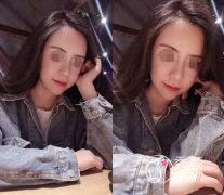 北京薛志强做鼻子鼻修复怎么样 案例