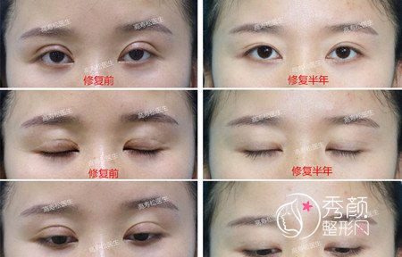杭州高寿松修复双眼皮怎么样|附双眼皮修复案例