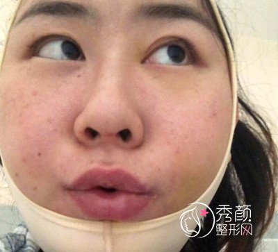上海九院切下颌角手术经历