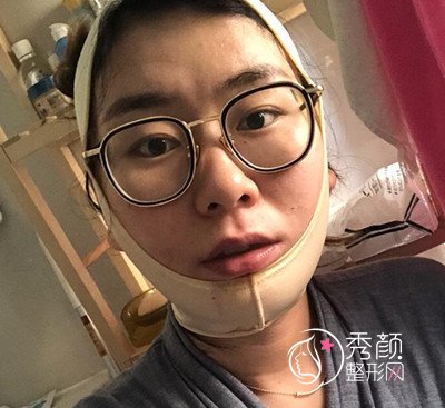 上海九院切下颌角手术经历