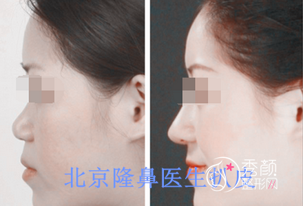 北京隆鼻医生大扒皮，审美技术风格分析，强势攻略。