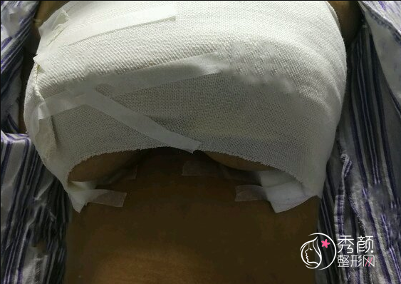 【缩胸手术案例记录】在杭州做的缩胸，快5个月了。