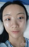 【案例】面部脂肪填充全过程曝光，较为详细的分享。