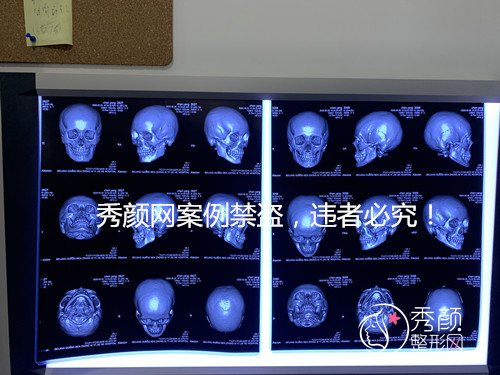 国内磨骨哪个医生好，北京热门磨骨医生一览。