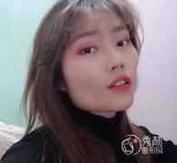 成都磨骨友谊张立天下颌角做的怎么样,案例分享。