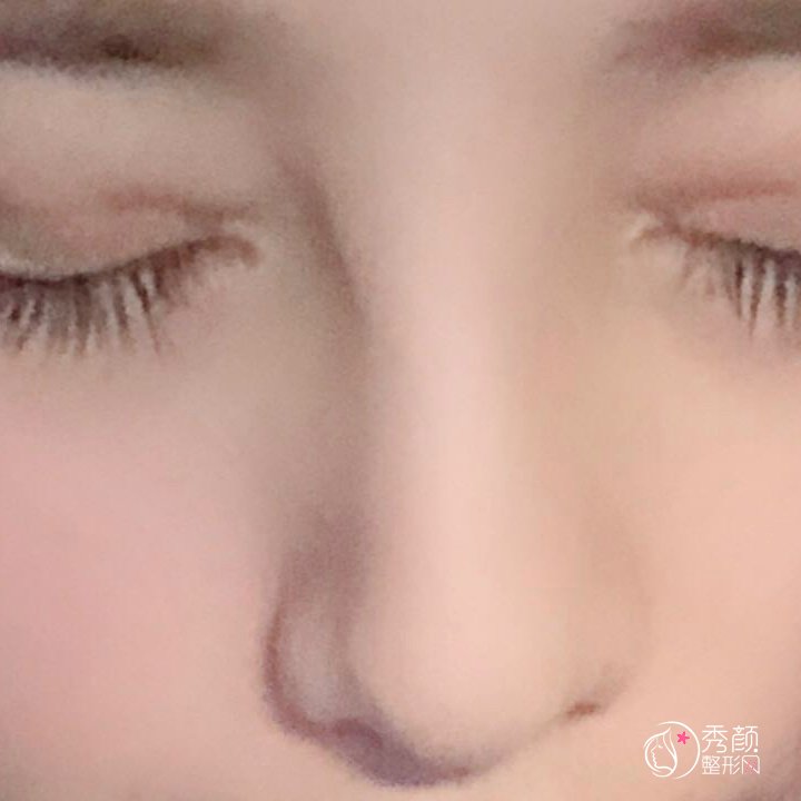 上海九院隆鼻失败经历分享!!!