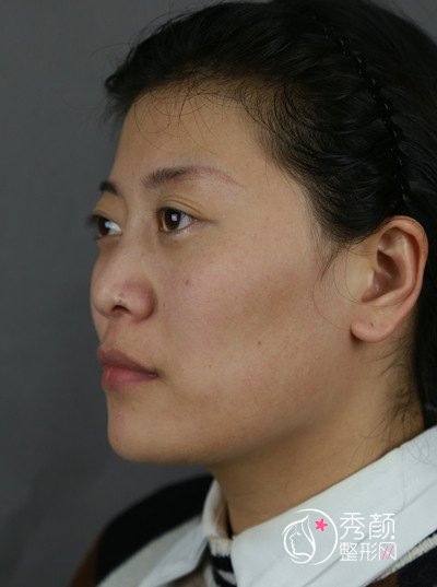 上海首尔丽格石润下颌角磨骨案例