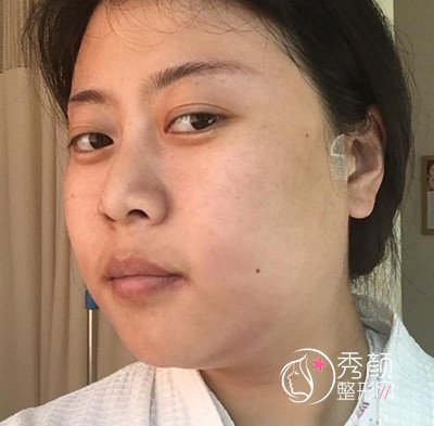 上海首尔丽格石润下颌角磨骨案例