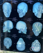 北京磨骨医生张笑天、何照华和黄大勇哪个好？