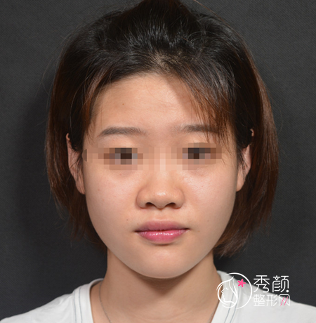 北京柏丽李劲良做鼻子怎么样,隆鼻案例分享。