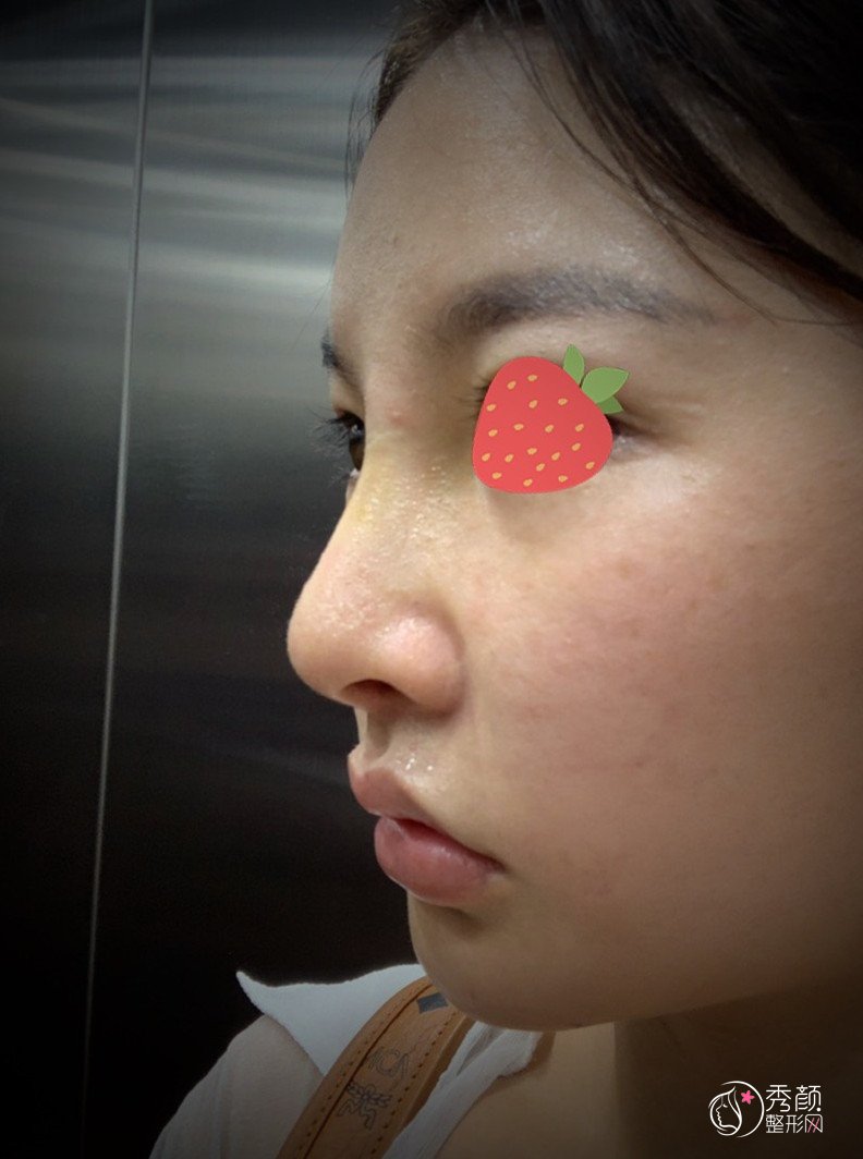 武汉哪个医生鼻修复做得好,刘波鼻修复案例。