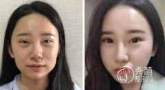 北京张大艳脂肪填充怎么样 有失败案例吗