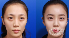 上海脂肪填充哪个医院医生好【攻略】