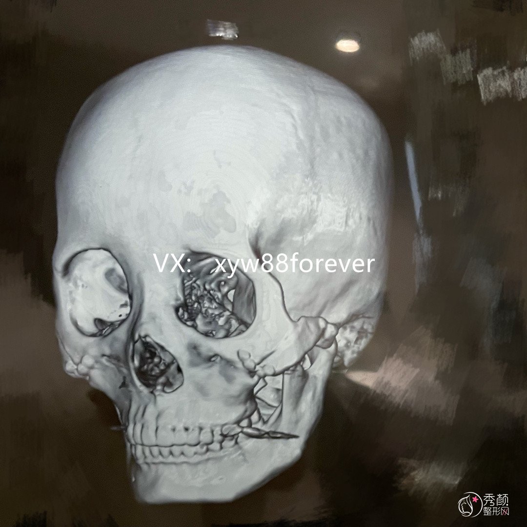 颧骨颧弓内推+下颌角失败修复,对比李志海、曹栋弼、朴兴植、章建林。