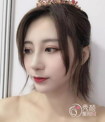 任东、向宏伟和陈海标做鼻子哪个好