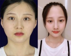 成都友谊整形磨骨怎么样，价格表曝光