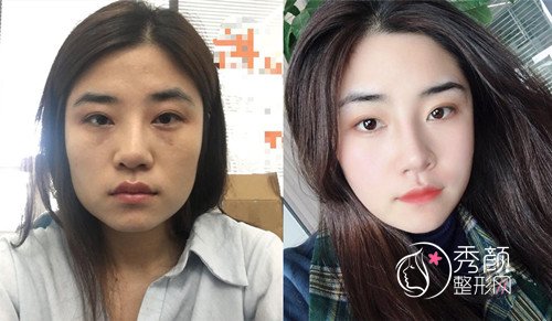 上海磨骨哪个医生好,金一秀和曹栋弼对比