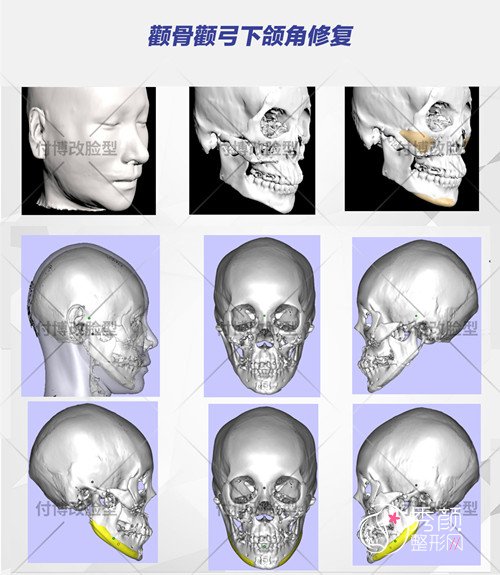 武汉华美付国友磨骨 颧骨内推 下颌角技术怎么样