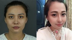 首尔丽格和美联臣磨骨哪个好,医生案例对比。