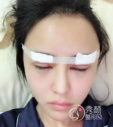 北京韩勋双眼皮修复费用|双眼皮修复案例曝光