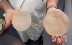 进口曼托隆胸多少价格，假体隆胸真实案例分享。