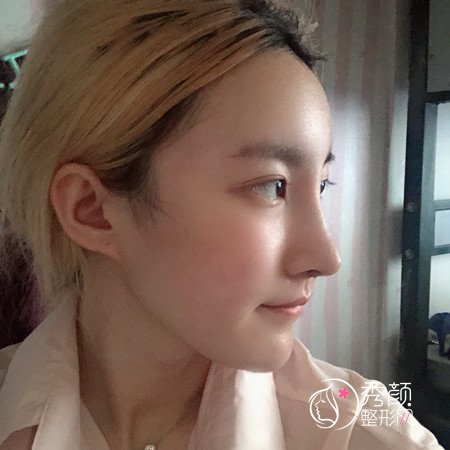 青岛华颜孙好杰隆鼻怎么样|案例曝光