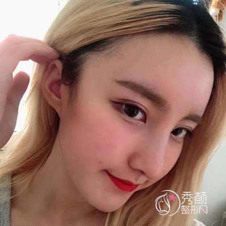 青岛华颜孙好杰隆鼻怎么样|案例曝光