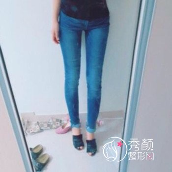 成都艾米莉潘红伟抽脂怎么样|案例曝光