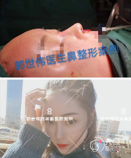 成都郭世伟隆鼻怎么样，有失败案例嘛？