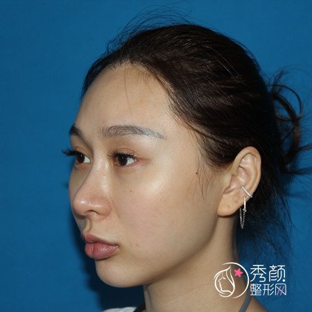 上海美联臣曹栋弼正颌手术/双鄂手术怎么样|案例曝光